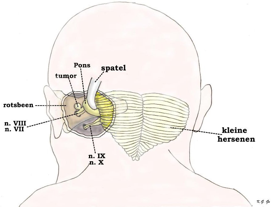 Anatomie Diagram Van Het Achterste Oor anatomie-diagram-van-het-achterste-oor